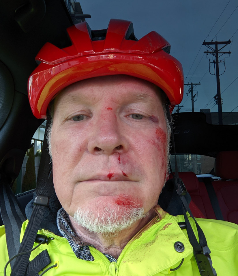 The author after a bike accident